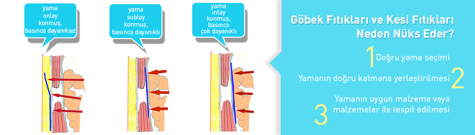 Göbek Fıtıkları ve Kesi Fıtıkları Neden Nüks Eder? neden-tekr-areder3
